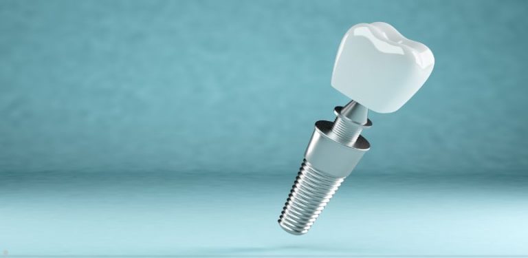 dental implants