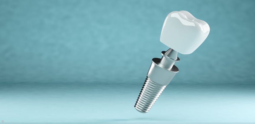 dental implants