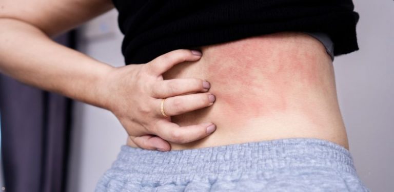 A woman scratching a red skin rash on her back.